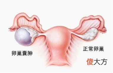 中医治疗子宫肌瘤的方法有哪些 中医怎样治疗子宫肌瘤