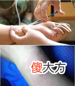 头孢类抗菌药物需要做皮试吗 头孢类药物需不需要做皮试