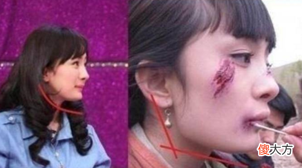 那些为此削骨而留下后遗症的明星们后悔了吗 整容削骨的后遗症