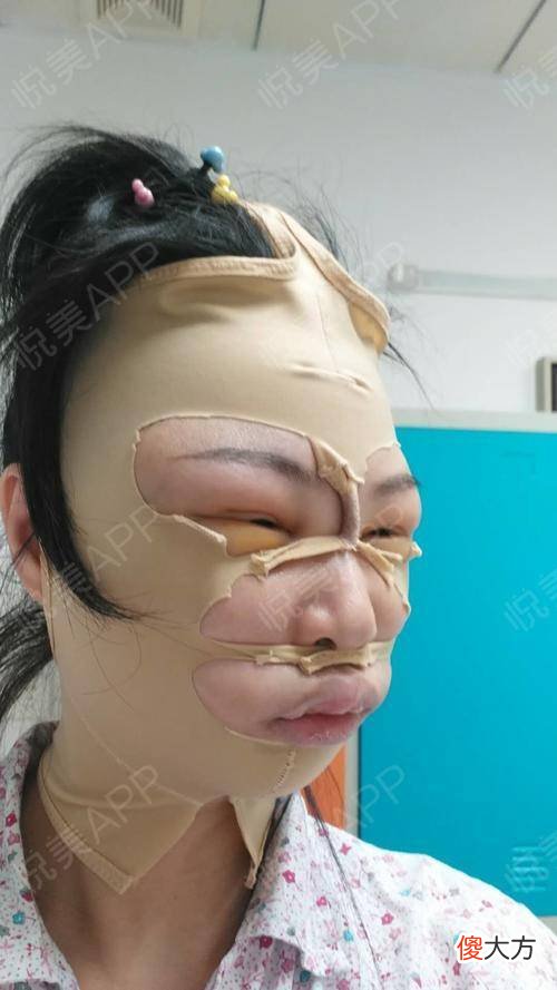那些为此削骨而留下后遗症的明星们后悔了吗 整容削骨的后遗症