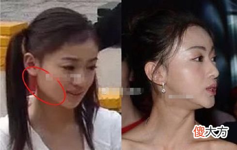 那些为此削骨而留下后遗症的明星们后悔了吗 整容削骨的后遗症