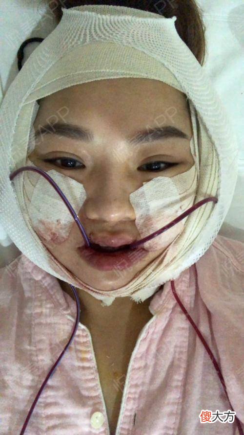 那些为此削骨而留下后遗症的明星们后悔了吗 整容削骨的后遗症