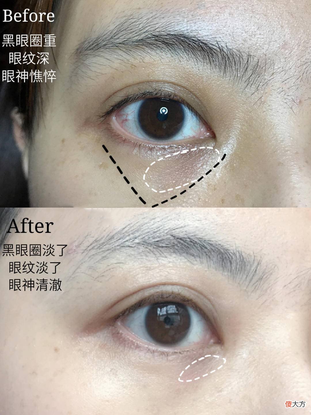 眼膜真的有用吗 眼膜真的有效吗