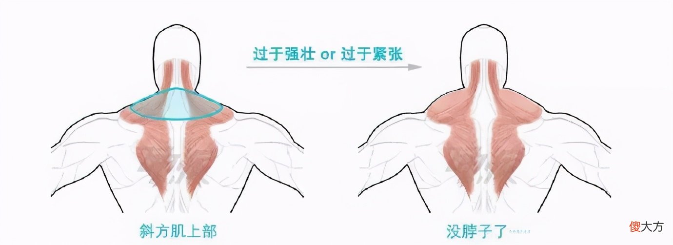 你的斜方肌还好吗 斜方肌不好看吗