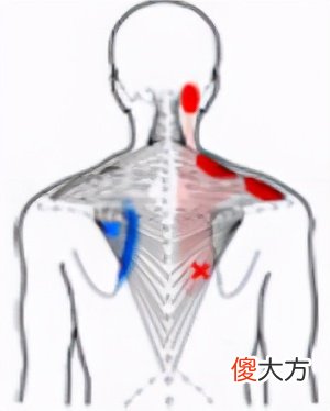 颈部疼痛与斜方肌损伤 斜方肌和颈部疼痛是怎么回事