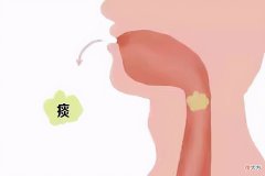 吐出的痰液颜色不同说明了什么 吐出的痰是红色的意味着什么