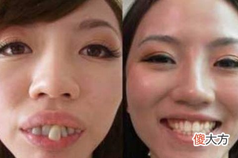 女人龅牙面相婚姻如何