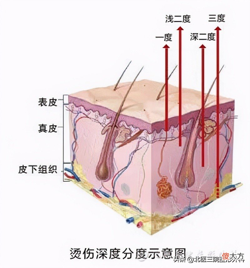 烫伤后怎么减少疤痕 烫伤如何消除疤痕
