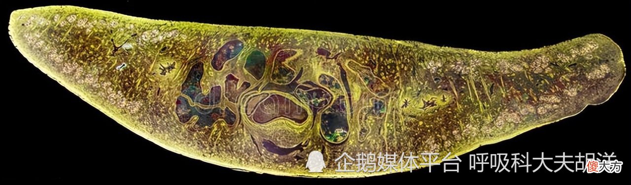 欧美多个国家现不明原因儿童肝炎，导致肝炎的病因到底有哪些？