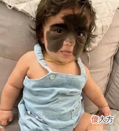 女孩出生后满脸胎记，被称蝙蝠女婴，7次手术后终化茧成蝶