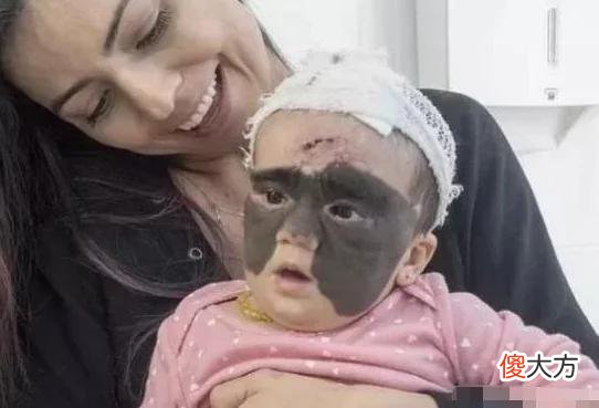 女孩出生后满脸胎记，被称蝙蝠女婴，7次手术后终化茧成蝶