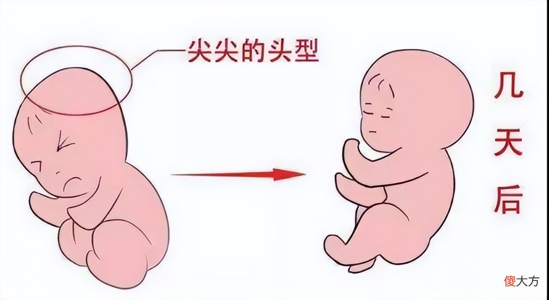 新生儿“先锋头”怎么办？医生：不是啥大病，建议试一试尿不湿