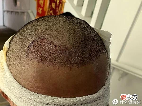【就爱时尚】植发拯救发际线成绩汇报，目前植完第8个月