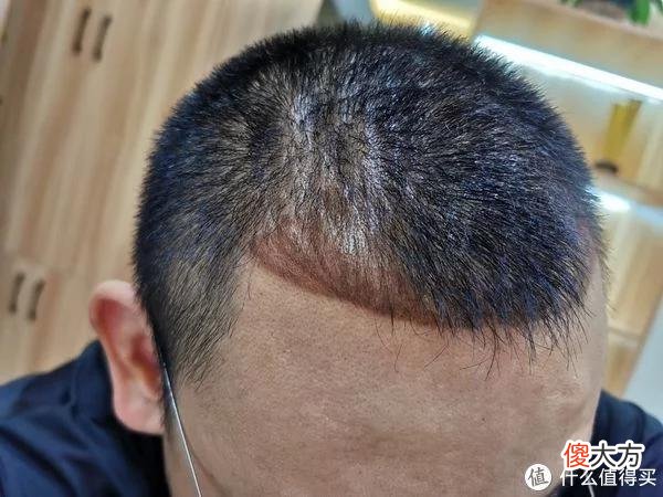 【就爱时尚】植发拯救发际线成绩汇报，目前植完第8个月