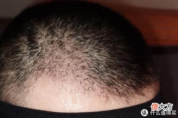 【就爱时尚】植发拯救发际线成绩汇报，目前植完第8个月