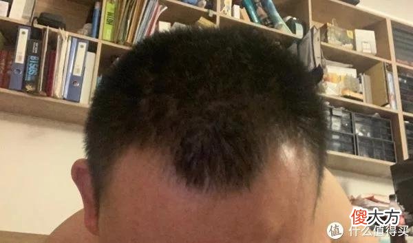 【就爱时尚】植发拯救发际线成绩汇报，目前植完第8个月