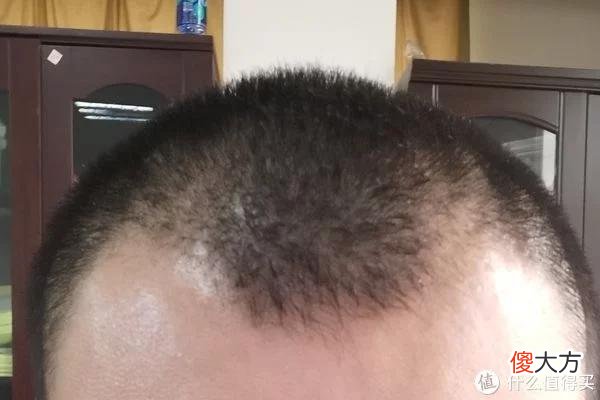 【就爱时尚】植发拯救发际线成绩汇报，目前植完第8个月