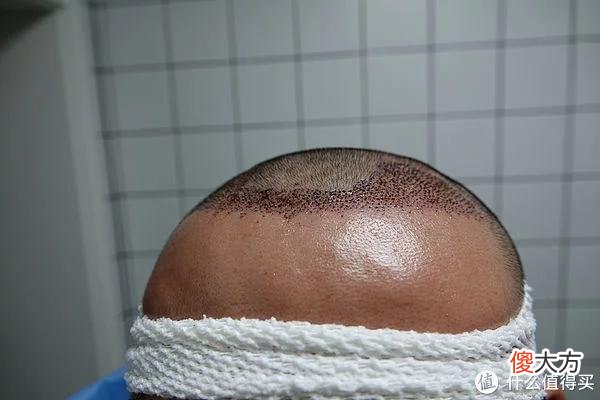 【就爱时尚】植发拯救发际线成绩汇报，目前植完第8个月