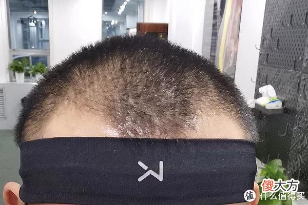 【就爱时尚】植发拯救发际线成绩汇报，目前植完第8个月