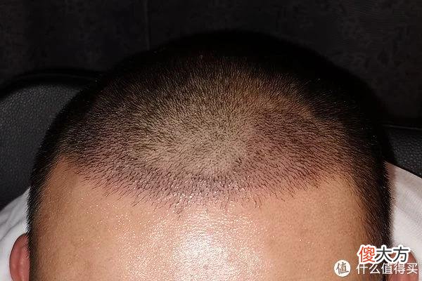 【就爱时尚】植发拯救发际线成绩汇报，目前植完第8个月