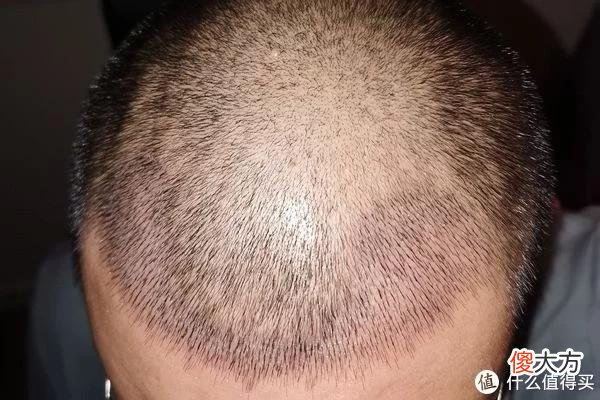 【就爱时尚】植发拯救发际线成绩汇报，目前植完第8个月