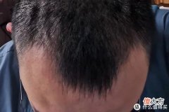 【就爱时尚】植发拯救发际线成绩汇报，目前植完第8个月