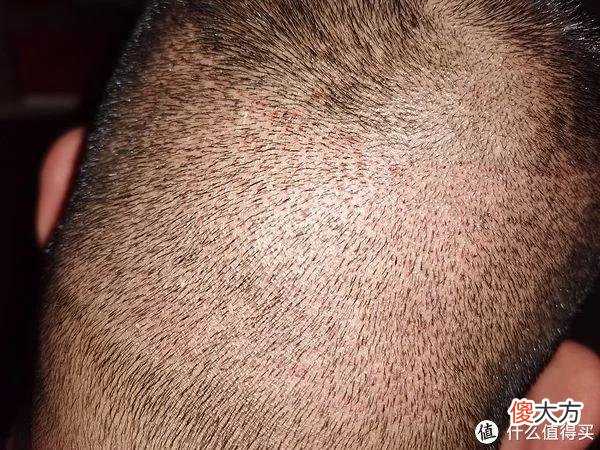 【就爱时尚】植发拯救发际线成绩汇报，目前植完第8个月