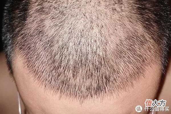 【就爱时尚】植发拯救发际线成绩汇报，目前植完第8个月