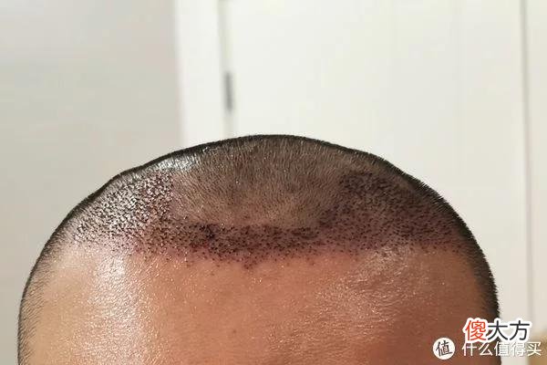 【就爱时尚】植发拯救发际线成绩汇报，目前植完第8个月