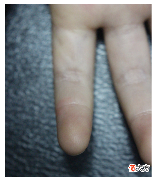 经常挠头，手指竟会变色？｜北京儿童医院团队BMJ发表病例