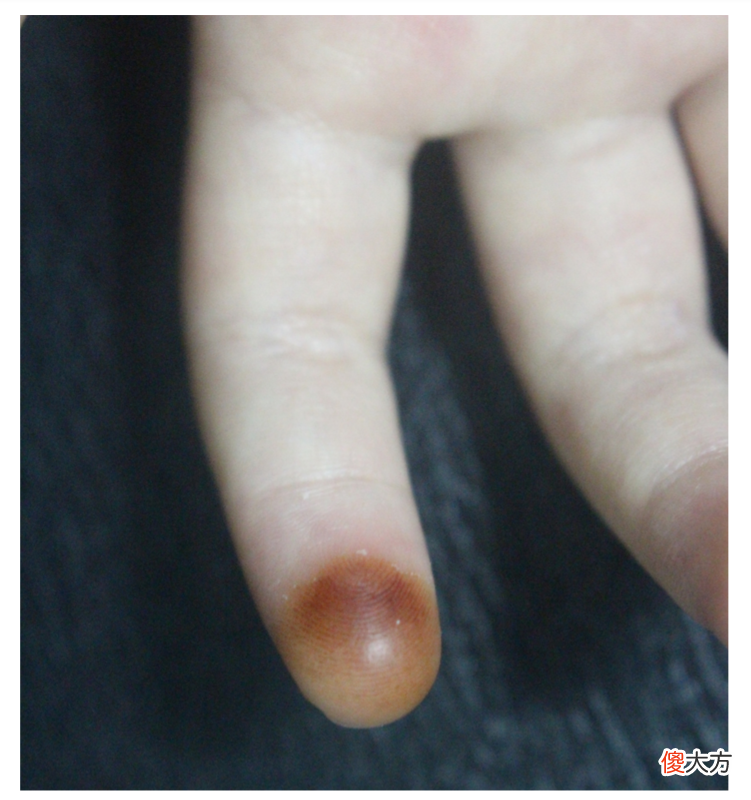 经常挠头，手指竟会变色？｜北京儿童医院团队BMJ发表病例