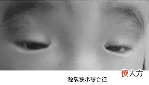 【时尚一点】开内眼角只是为了好看？不开可以吗？杭州美莱美容医院告诉你