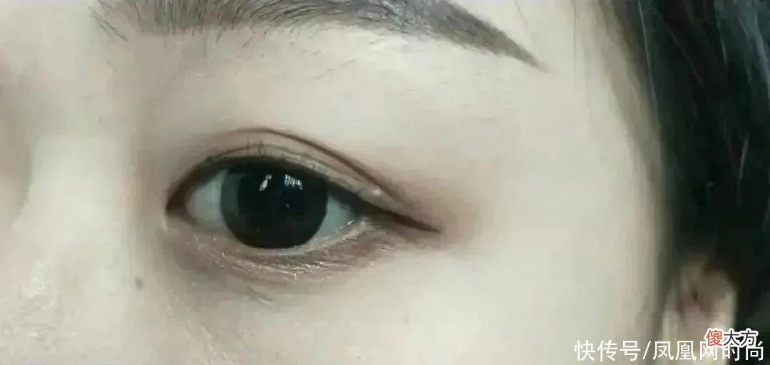 【就爱时尚】长了脂肪粒到底挤不挤？一分钟教你处理它的正确方式