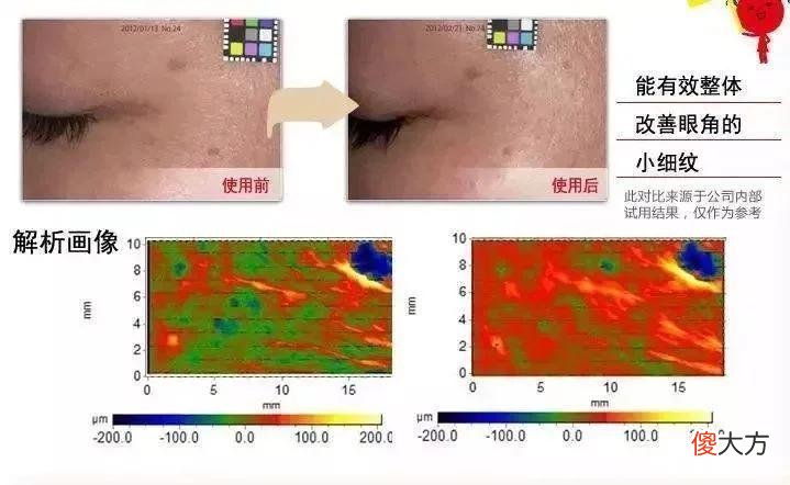 【就爱时尚】长了脂肪粒到底挤不挤？一分钟教你处理它的正确方式