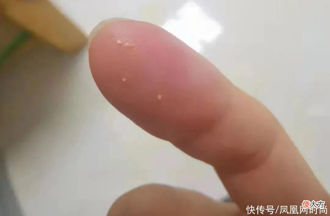 【就爱时尚】长了脂肪粒到底挤不挤？一分钟教你处理它的正确方式