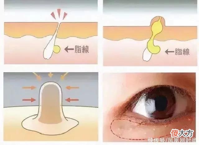 【就爱时尚】长了脂肪粒到底挤不挤？一分钟教你处理它的正确方式