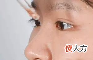 【就爱时尚】长了脂肪粒到底挤不挤？一分钟教你处理它的正确方式