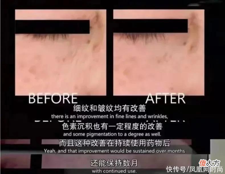 【就爱时尚】长了脂肪粒到底挤不挤？一分钟教你处理它的正确方式