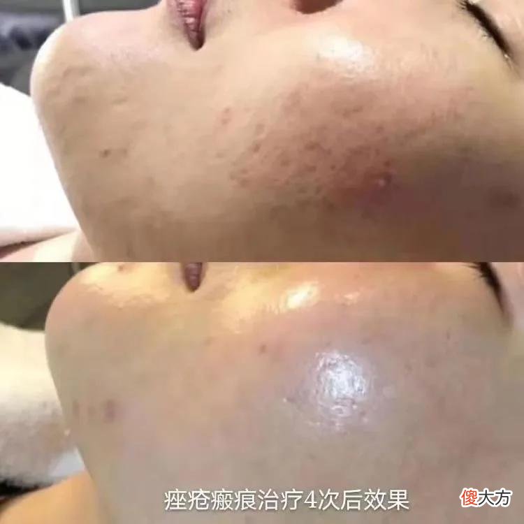 【时尚一点】痘痘好了，但遗留下来的“伤疤”难以治愈怎么办？