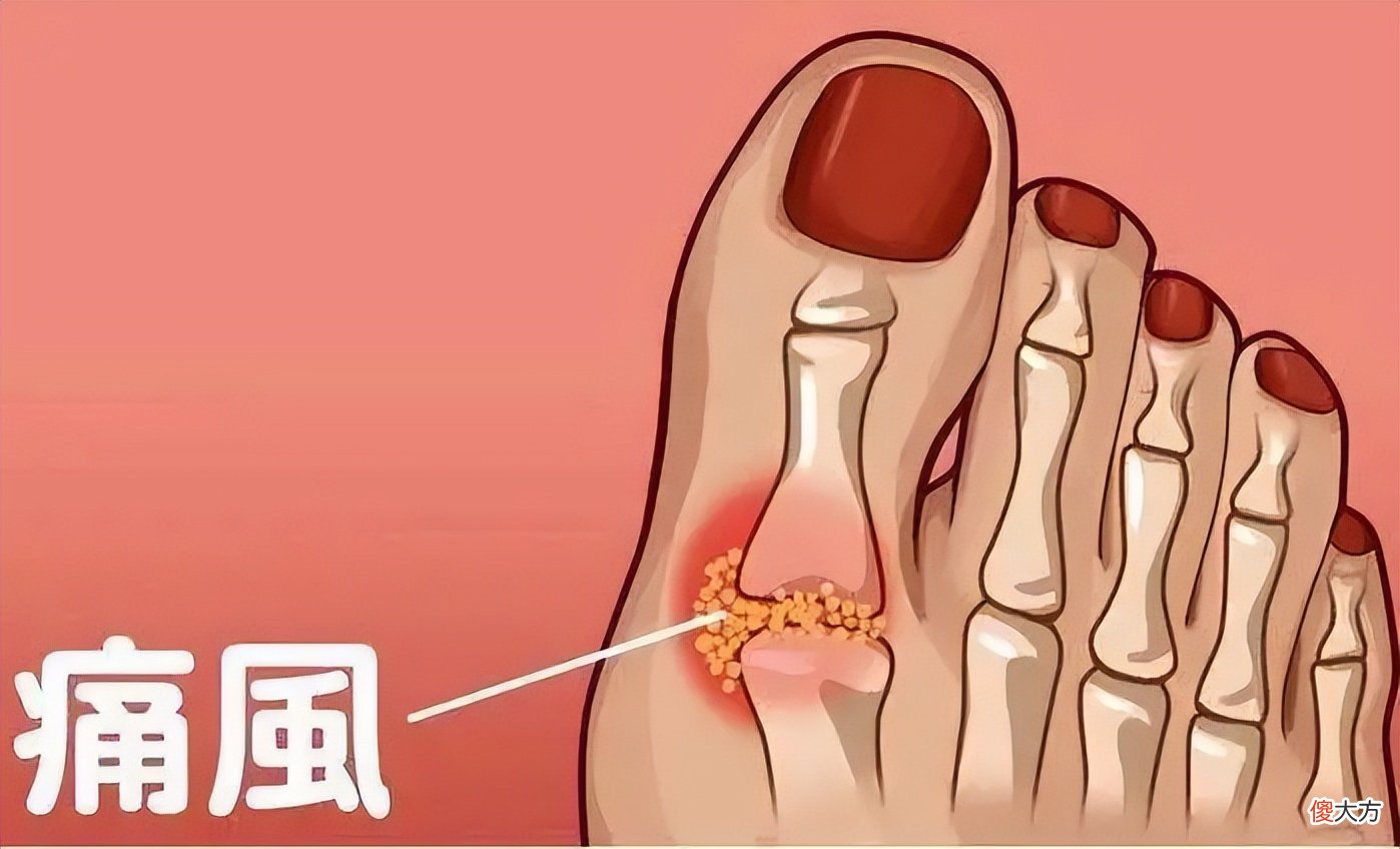 小苏打治疗痛风真的有用吗 小苏打能不能治痛风