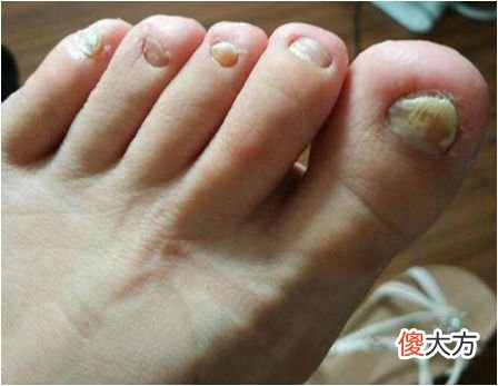 讨厌的灰指甲 灰指甲好烦