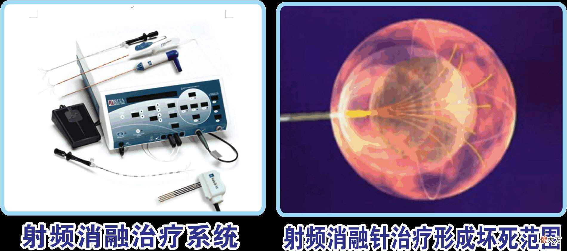 消融手术是什么？可以治疗哪些疾病？