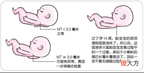 NT检查到底是什么 nt到底是检查什么的