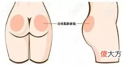 【时尚一点】任学会脂肪丰臀行不行？自体脂肪丰臀如何？