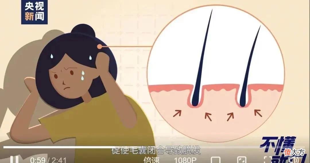 【就爱时尚】怕秃头，女子3个月不洗头！结果悲剧了