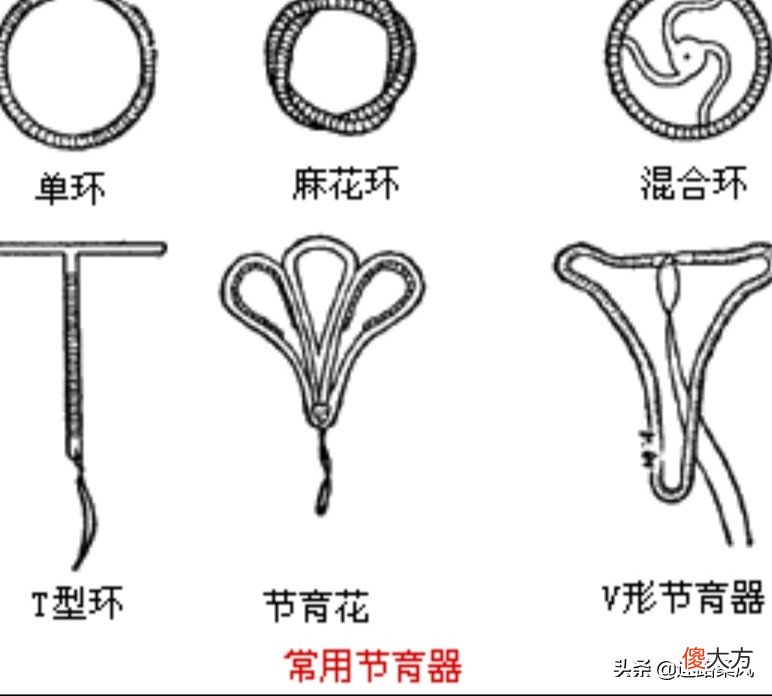 女同胞们，有上过环的吗？节育环是什么东西，大家听说过吗？以我的亲身经历