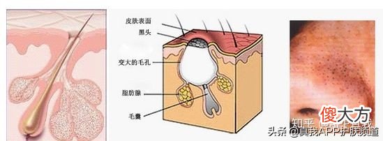 不能不看的去黑头攻略 怎么去除黑头