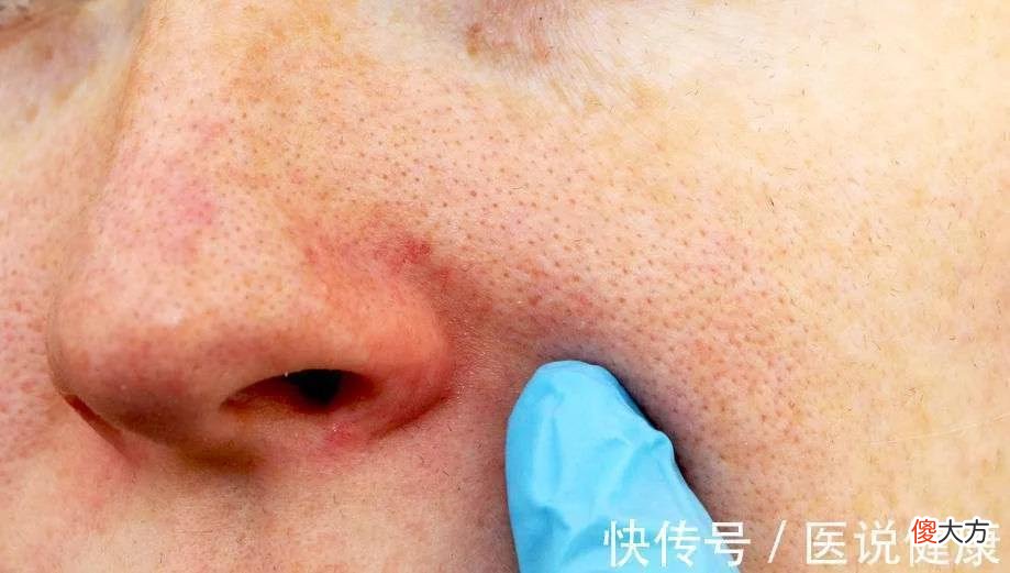 【就爱时尚】研究称面部螨虫与人类将合体？这3种迹象，都暗示脸上螨虫过多