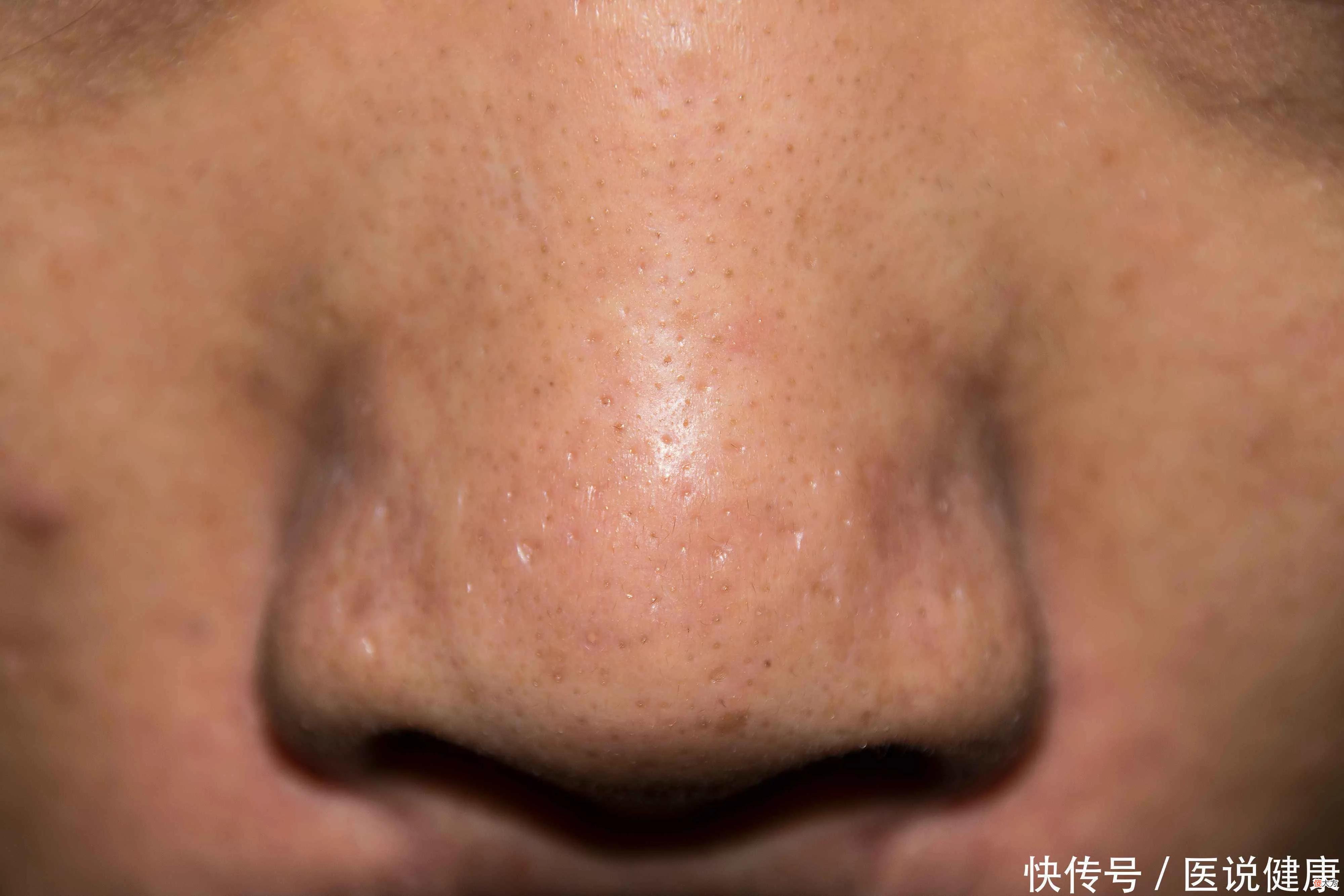 【就爱时尚】研究称面部螨虫与人类将合体？这3种迹象，都暗示脸上螨虫过多