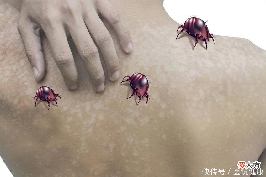 【就爱时尚】研究称面部螨虫与人类将合体？这3种迹象，都暗示脸上螨虫过多